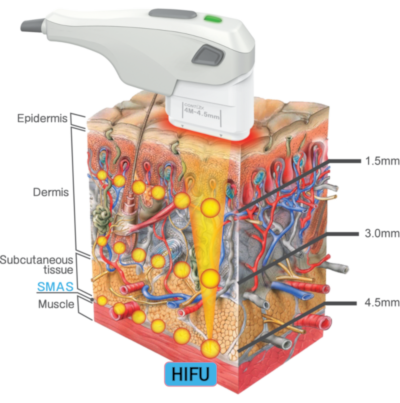 KSAE Beauty HIFU Ultraschall Haut