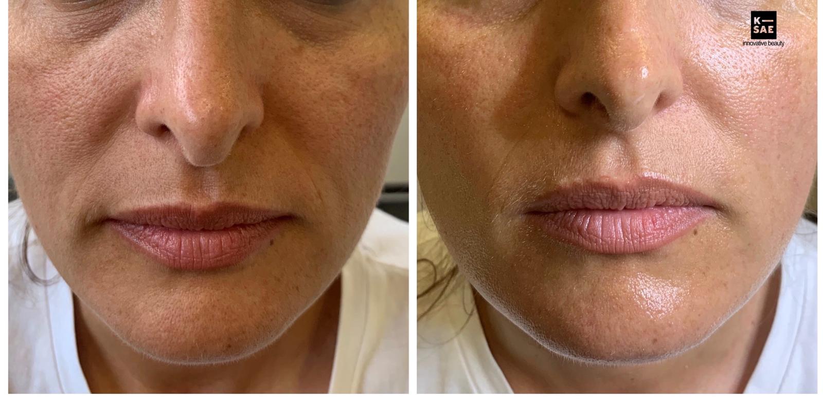 Hifu Ultraschall Facelift Facelift Behandlung Stuttgart K Sae Beauty