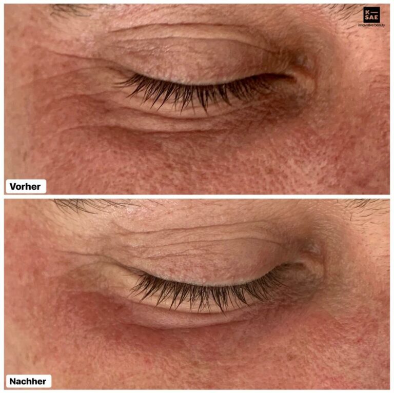 RADIOFREQUENZMICRONEEDLING KSAE BEAUTY